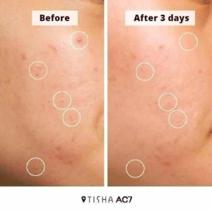 tisha-ac7-acne-spot-serum-15ml-pic-6